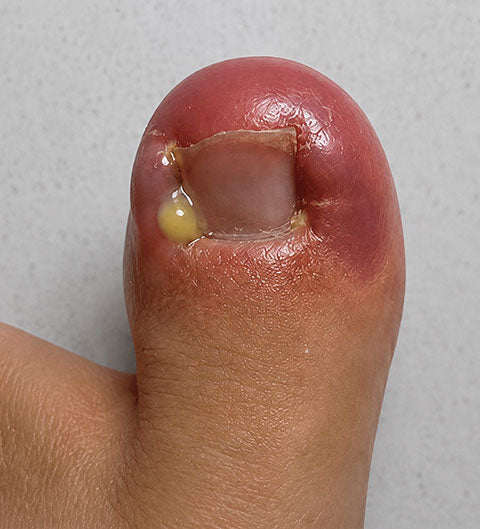 Severe Complications