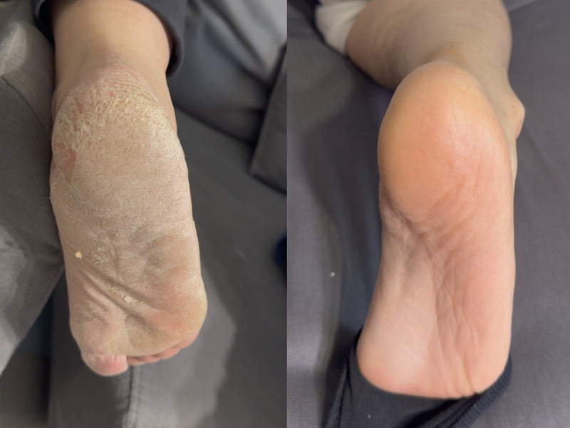 Dry cracked heels before and after using ClearZal Foot Food