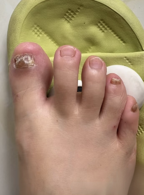 Thickened nails begin to thin.