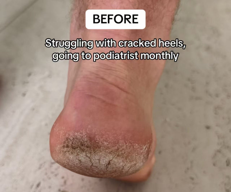 Resurfacing (Day 7)