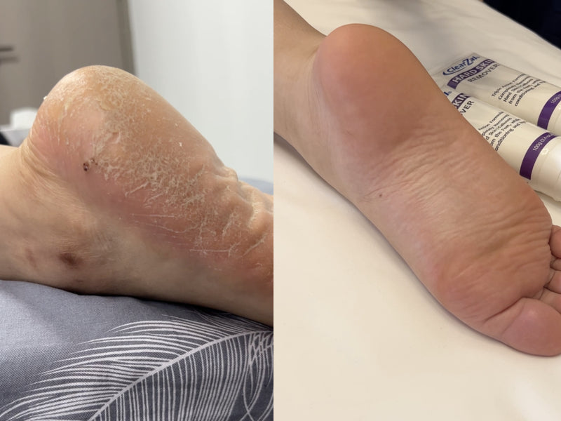 Discoloured toenails before and after