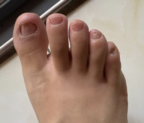The nail bed recovers as damaged nail slowly separates.