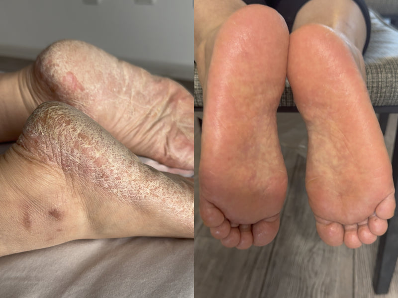 Severe nail condition before and after