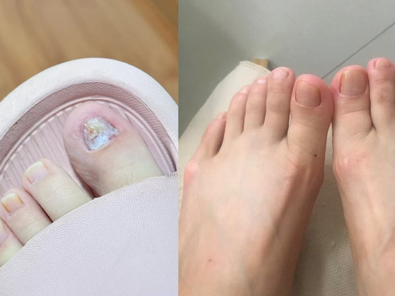Discoloured toenails before and after