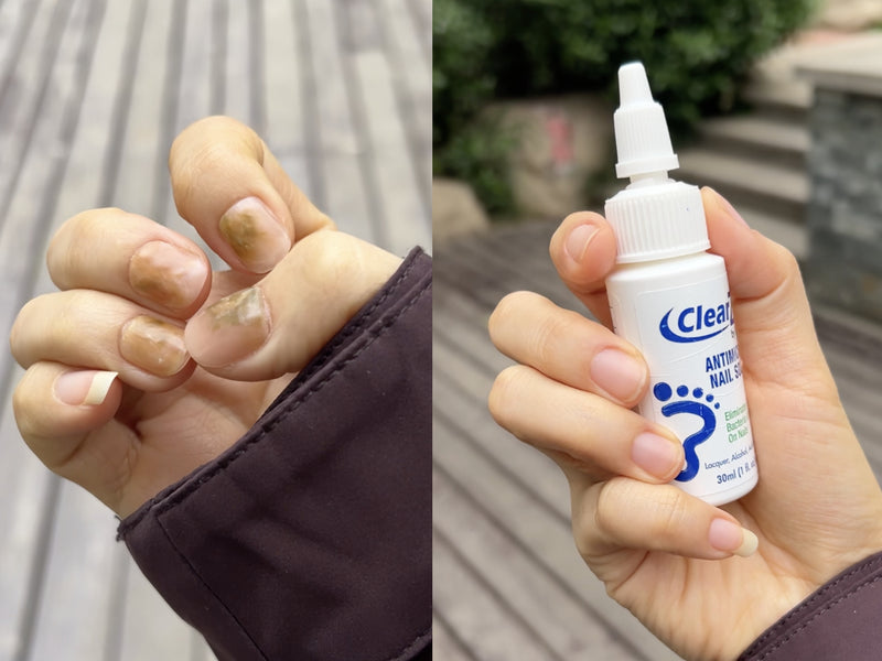 Dry cracked heels before and after using ClearZal Foot Food