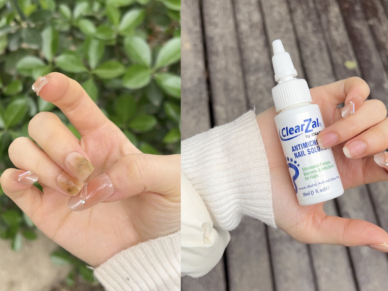 Severe nail condition before and after