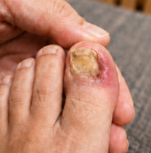 For Nail Fungus Sufferers,