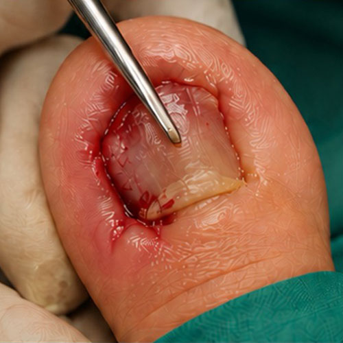 A Painful Procedure
